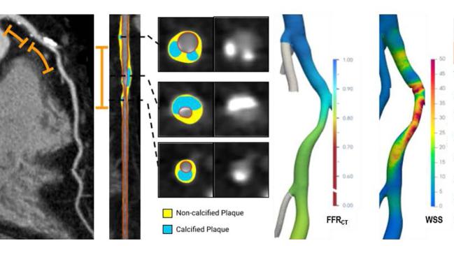 AI Assessment of Plaque, Hemodynamics May ID Lesion-Specific ACS Risk